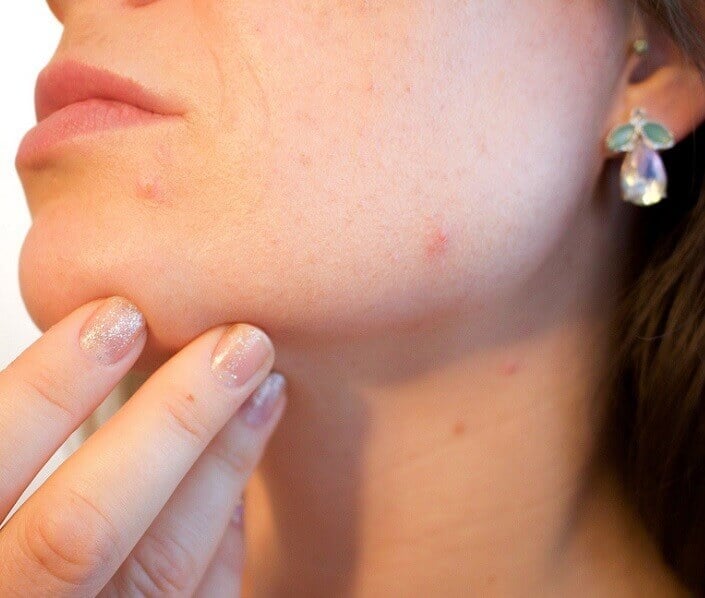 Side of a woman's face with spots